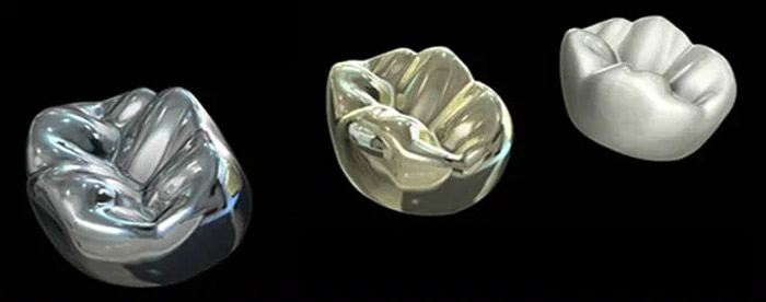 Corona dental de metal y porcelana – Tipos, ventajas, desventajas
